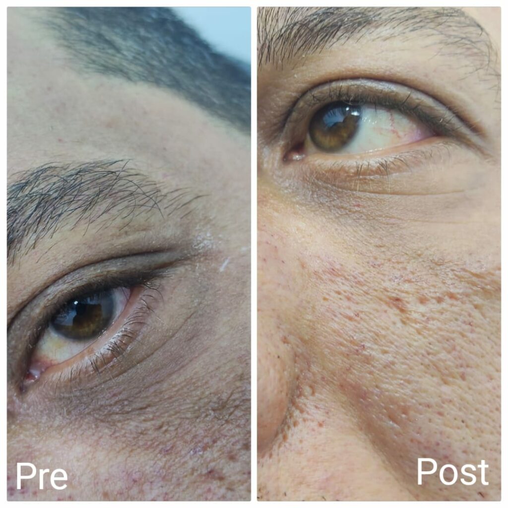 Instant improvement in dark circles under the eyes for men